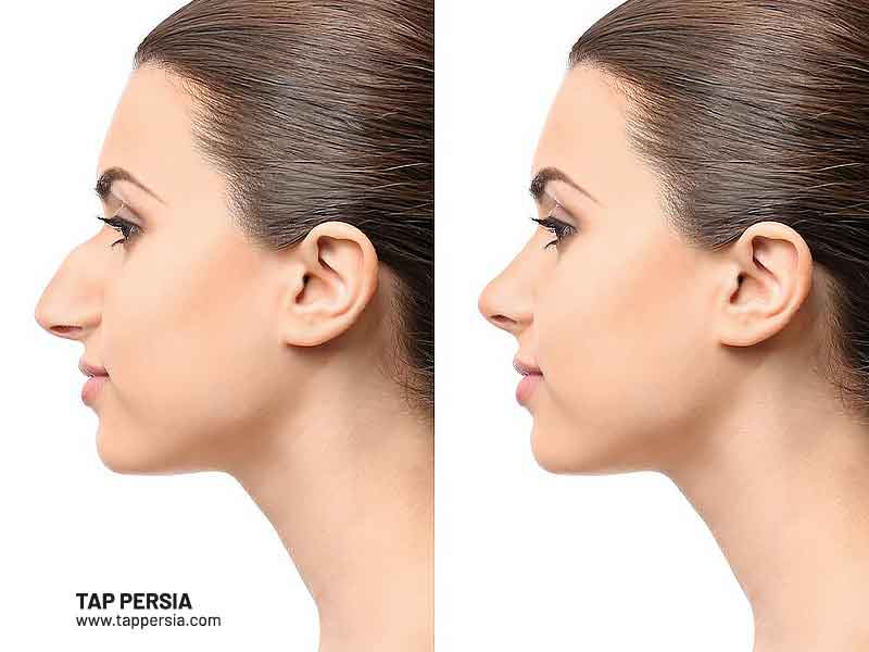 Rhinoplasty in Turkey vs. Iran