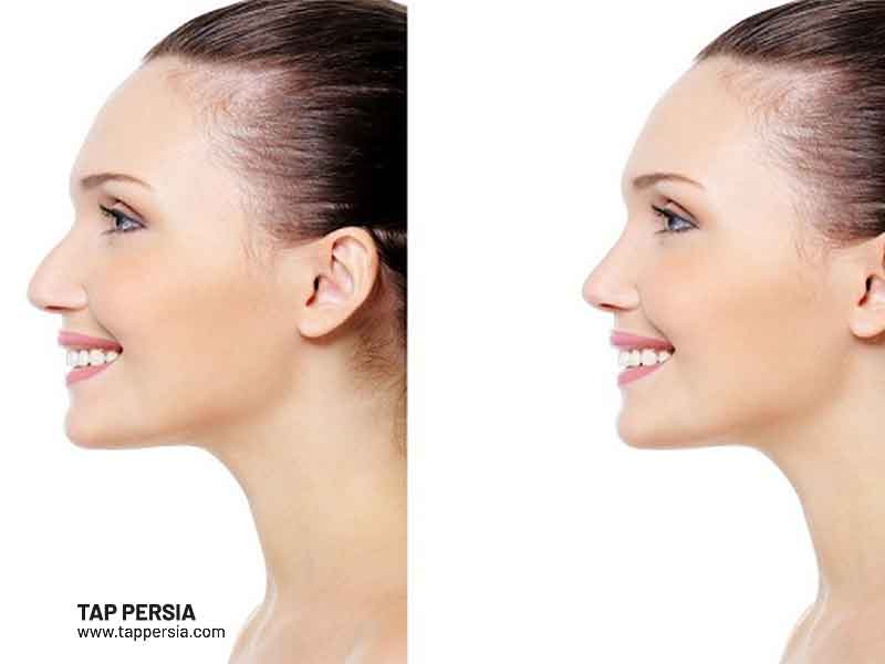 Factors Influencing the Cost of Nose Job in Iran