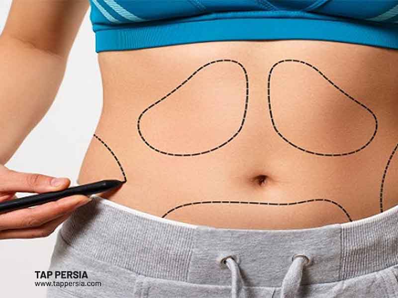 Before Doing Liposuction in Iran
