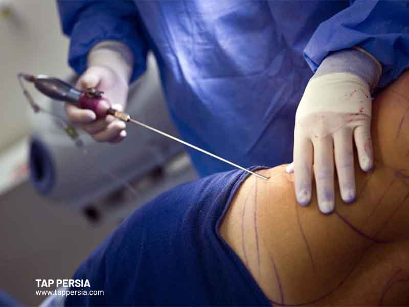 Cost of Liposuction in Iran