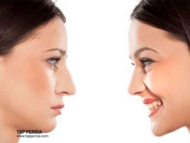 Who Can Benefit from Nose Job in Iran?