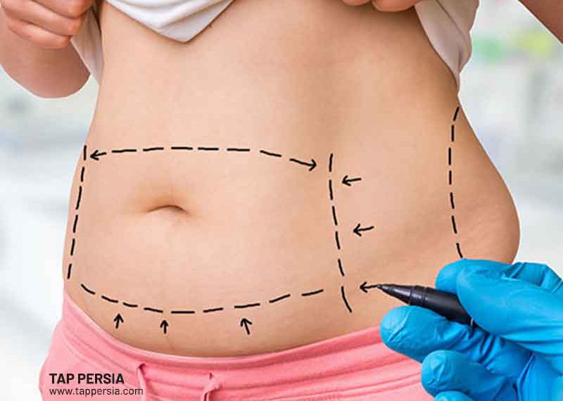 Is Liposuction Safe?