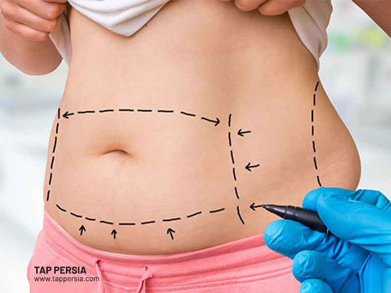 Is Liposuction Safe?