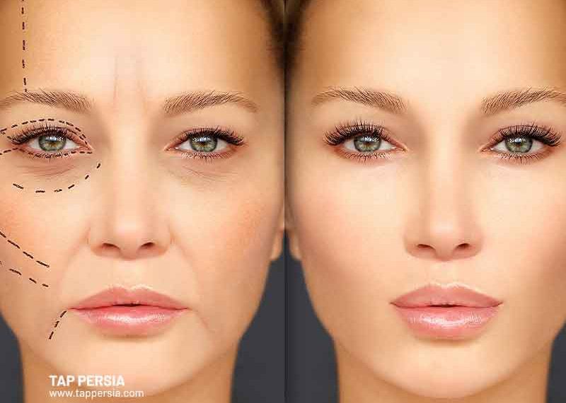 Is-Plastic-Surgery-Common-in-Iran