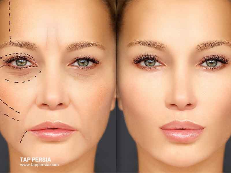 Is-Plastic-Surgery-Common-in-Iran