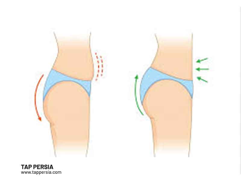 Price of BBL Surgery in Iran 